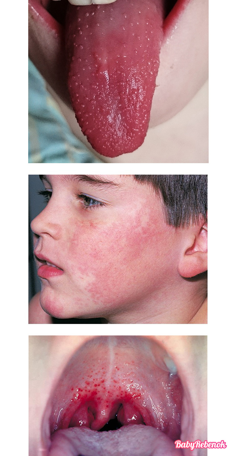 Як лікувати скарлатину у дітей