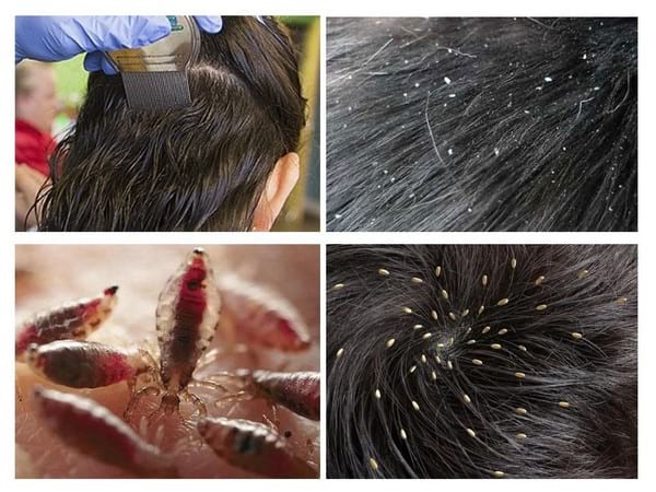 Як народними засобами вивести воші